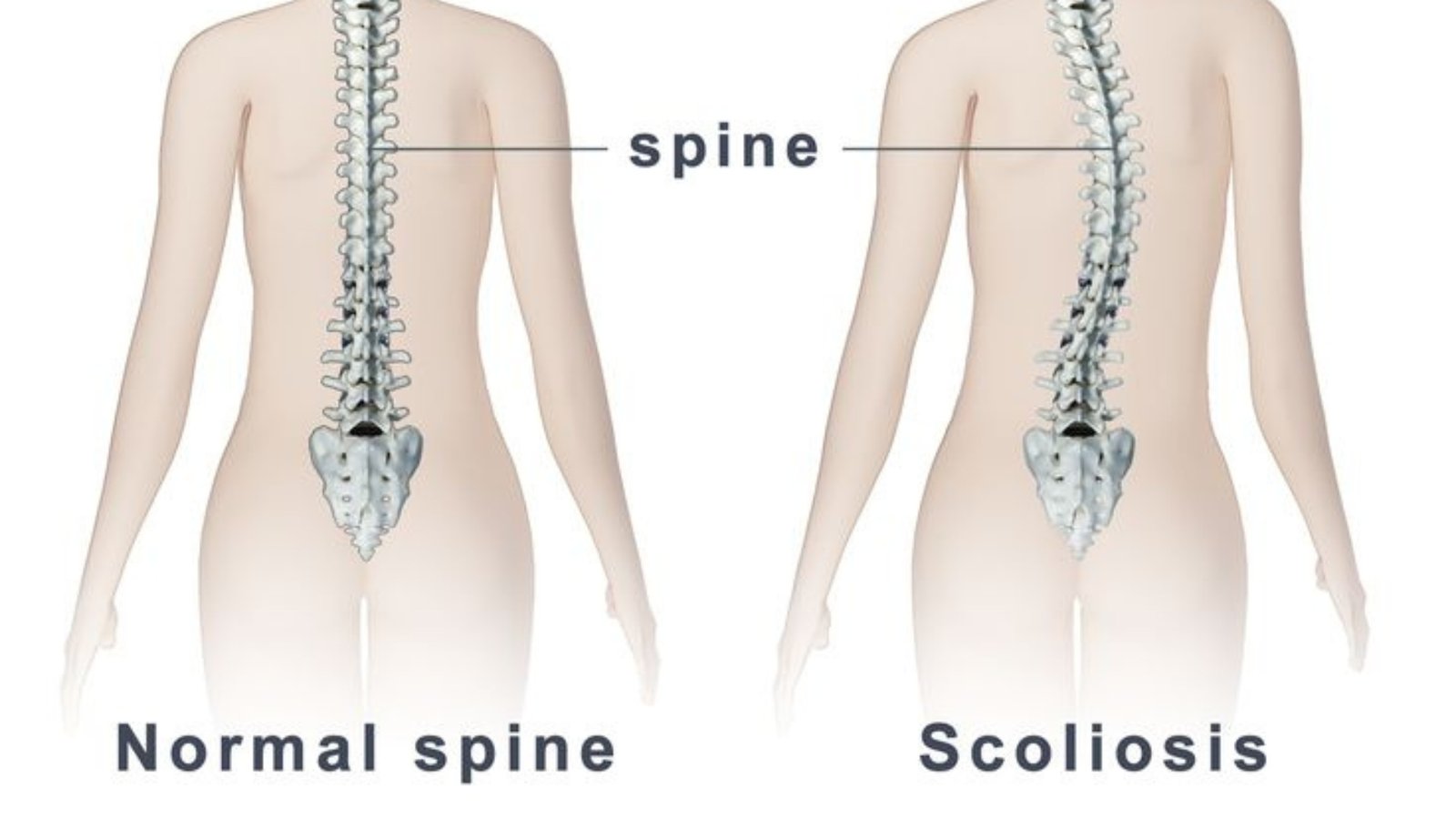 Scoliosis treatment-Expert care Guide By Dr Rahul Grover