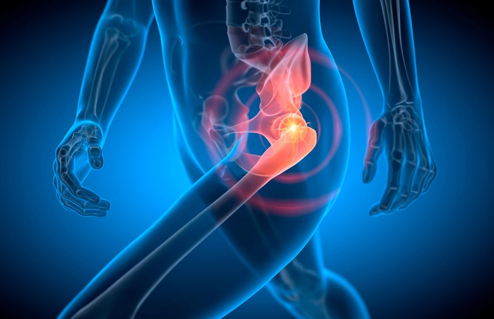 Hip Replacement Surgery with Dr.Rahul Grover