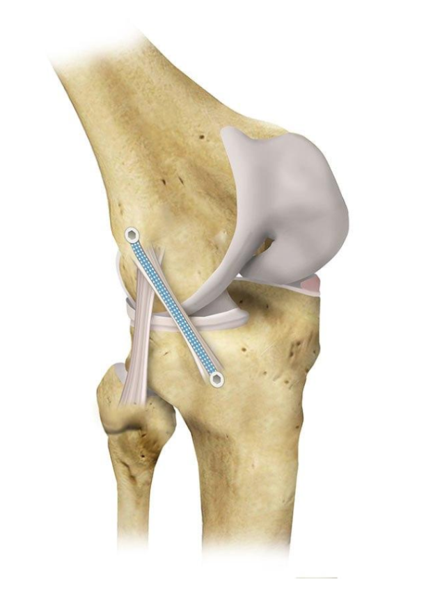 Anterolateral Ligament internal brace illustration