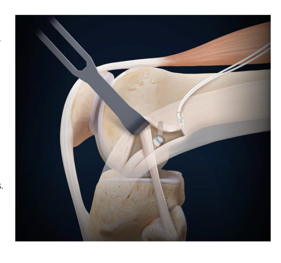 Lateral Extra-Articular Tenodesis illustration