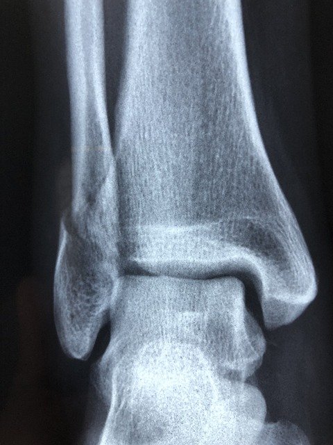 Fracture diagnostic care