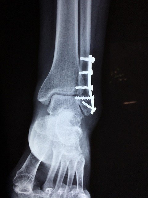 Post-fixation fracture X-ray with plate and screws